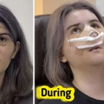 Woman Reveals Dramatic Transformation After Plastic Surgery in South Korea