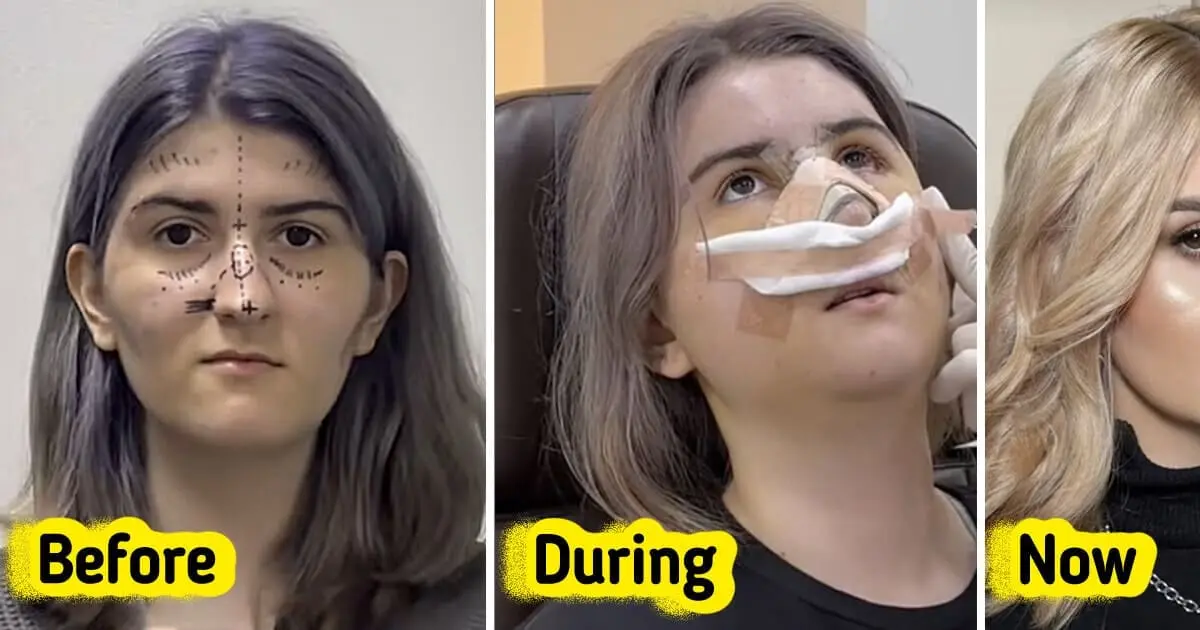 Woman Reveals Dramatic Transformation After Plastic Surgery in South Korea