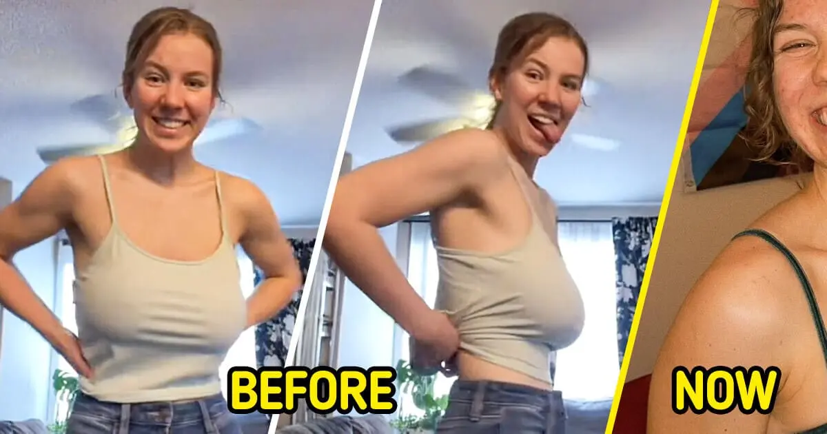 Woman Documents Her Breast Reduction Surgery, and Shocks Everyone With the Results